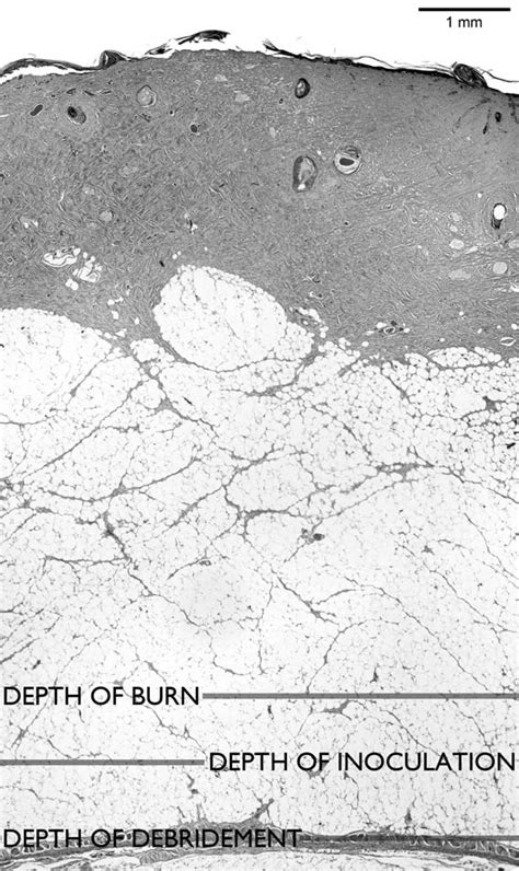 measuring burn depth thickness researchgate|Burn depth and its histological measurement .